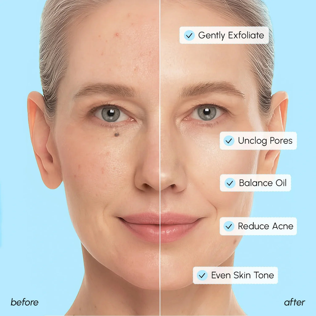 Disques Peeling Acide Glycolique & Salicylique