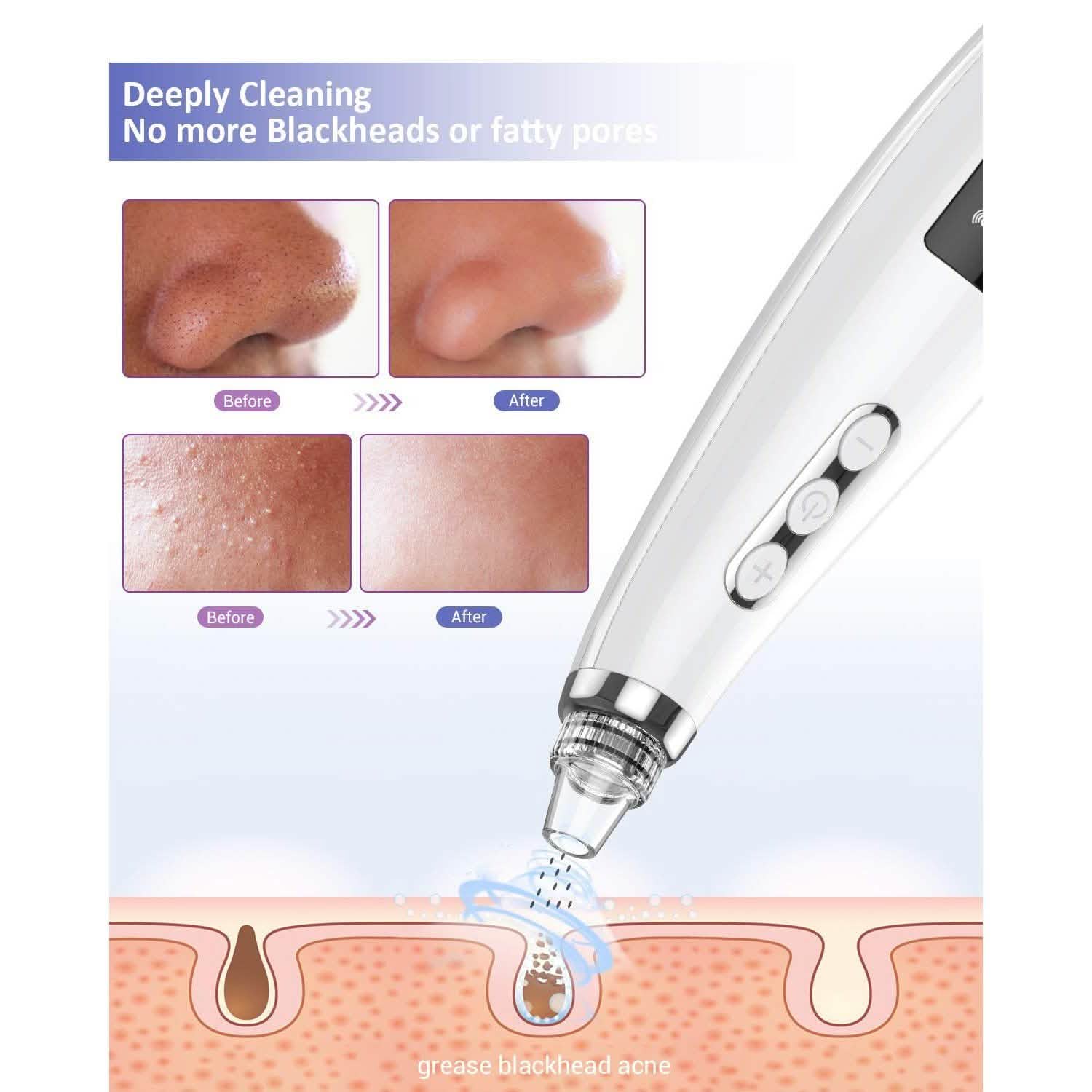 Extracteur de points noirs et nettoyeur de pores