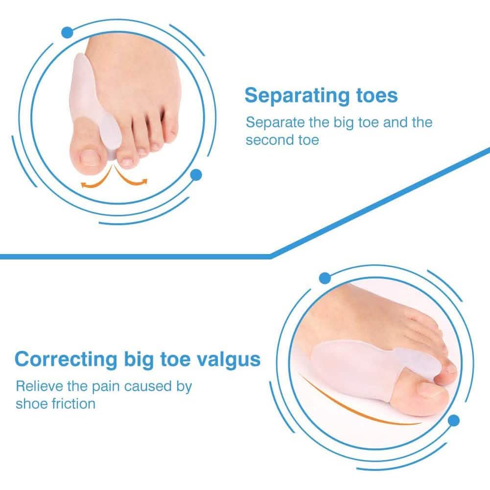 Correcteur d'oignon, redresseur d'hallux valgus, soulagement de la douleur