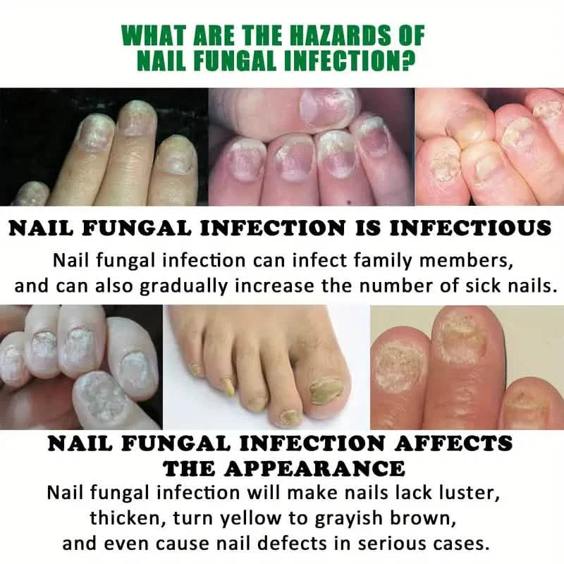 Liquide de soin des ongles au gingembre, Réparation des mycoses des ongles, Soin des ongles des mains et des pieds