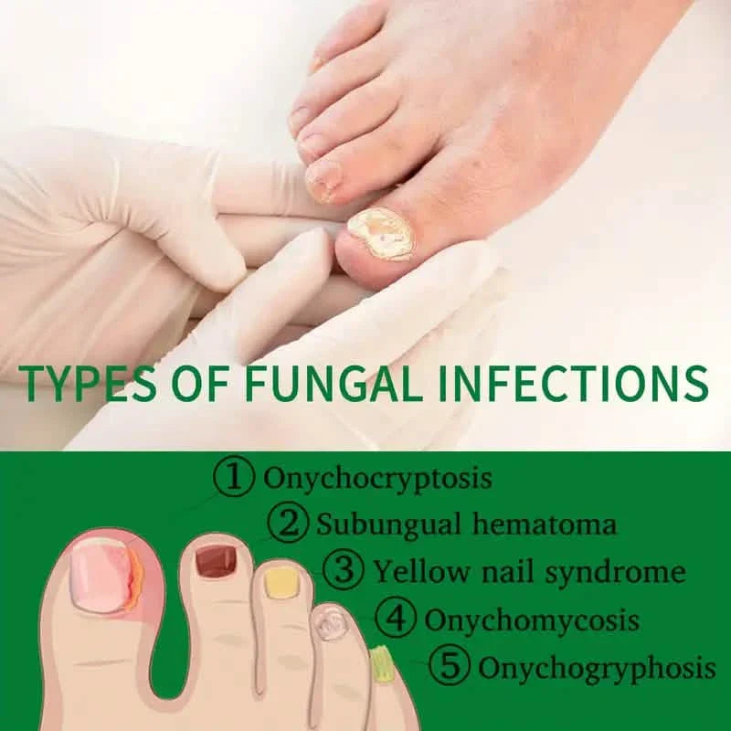Liquide de soin des ongles au gingembre, Réparation des mycoses des ongles, Soin des ongles des mains et des pieds