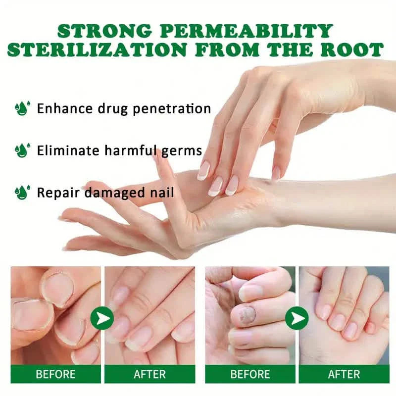Liquide de soin des ongles au gingembre, Réparation des mycoses des ongles, Soin des ongles des mains et des pieds